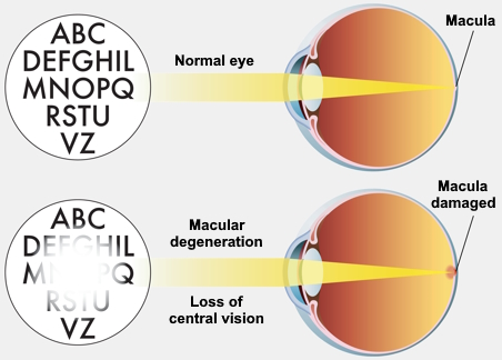 Macular degeneration diagram